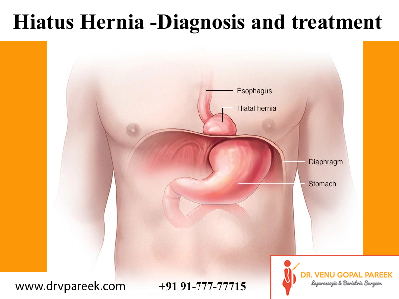 Best hiatus hernia medical treatment in Hyderabad, inguinal hernia doctor near Secunderabad