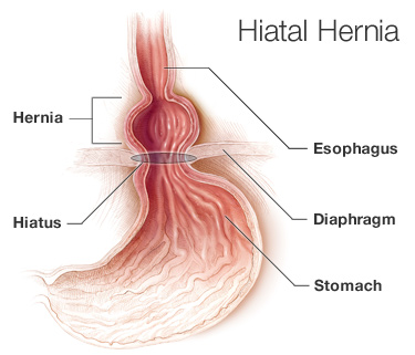 Best Clinic for Hiatal Hernia in Hyderabad, hiatal hernia specialist near Secunderabad