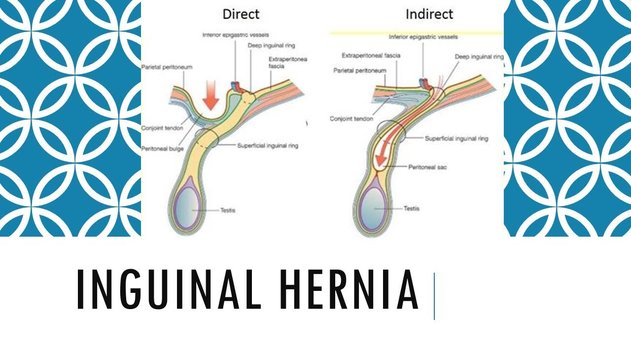 Direct Inguinal Hernia Tipos De Hernias Inguinales Directas E Direct Inguinal Hernia Tipos De Hernias Inguinales Directas E