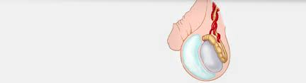Contact Dr. Venugopal Pareek to Know Causes of Hydrocele and preventive guide, hydrocele specialist near Secunderabad