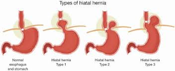 The best Hospital for all types of Hiatal Hernia treatment in Hyderabad, inguinal hernia specialists near me