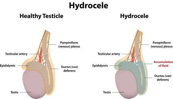 Consult Dr. Venugopal Pareek for the best Hyderocele surgery, One of the best Hydrocele surgeons in Hyderabad