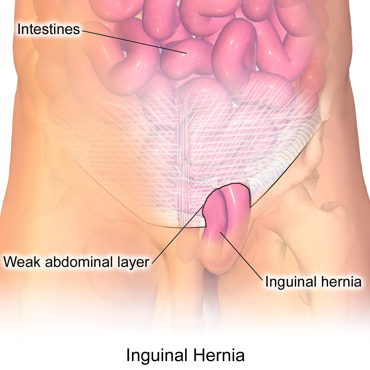 Inguinal hernia surgery cost in Hyderabad, best hernia specialist near Secunderabad