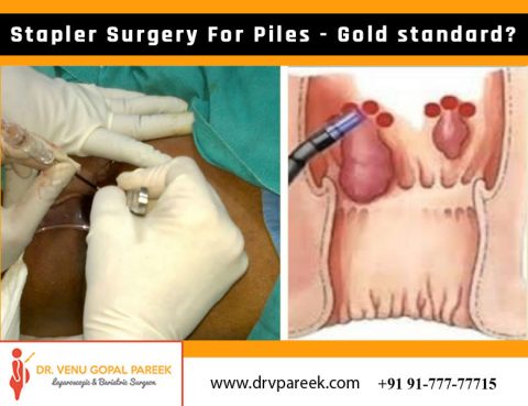 Best clinic for stapler Haemorrhoids in Hyderabad, the best hospital for piles treatment near Secunderabad