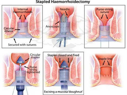 Painless stapled hemorrhoidectomy surgery center in Hyderabad, piles treatment doctor near Secunderabad