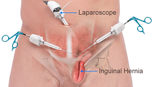 Laparoscopic Inguinal Hernia Repair in Hyderabad, umbilical hernia doctor near me