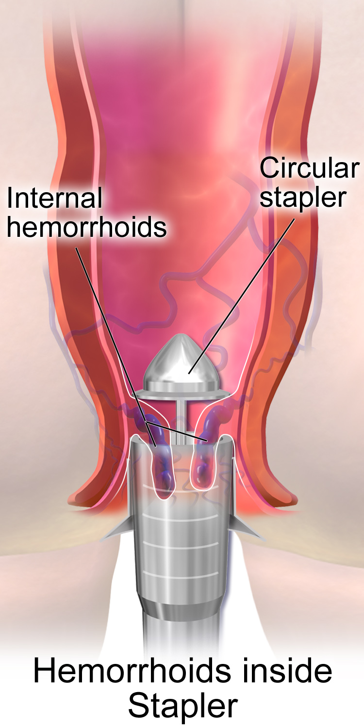 Best Inside Haemorrhoids stapler surgery in Hyderabad piles best therapist near Secunderabad