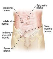 Best center for all types of Hernia surgery in Hyderabad, best hernia specialist surgeon near Secunderabad
