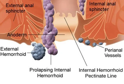 Contact Dr. Venugopal Pareek to Know everything about Your Haemorrhoids, One of the best Piles treatment doctor in Hyderabad