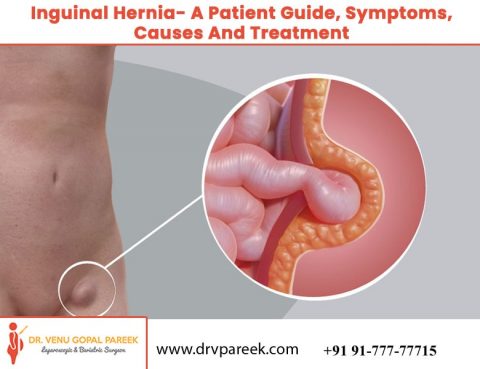 The ultimate guide of Inguinal Hernia by Dr. Venugopal Pareek, One of the best Hernias Specialists in Hyderabad