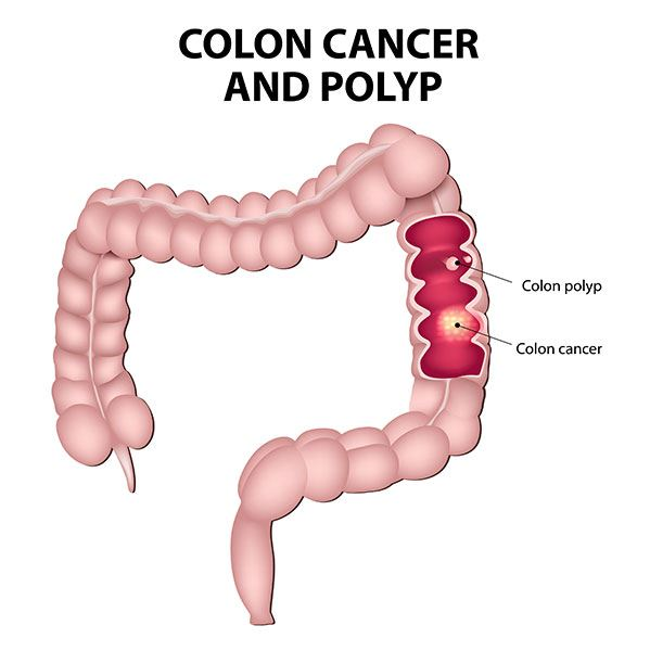 Colorectal Cancer and Polyps at Dr. Venugopal Pareek clinic, One of the best Bariatric Surgery Centers in Hyderabad