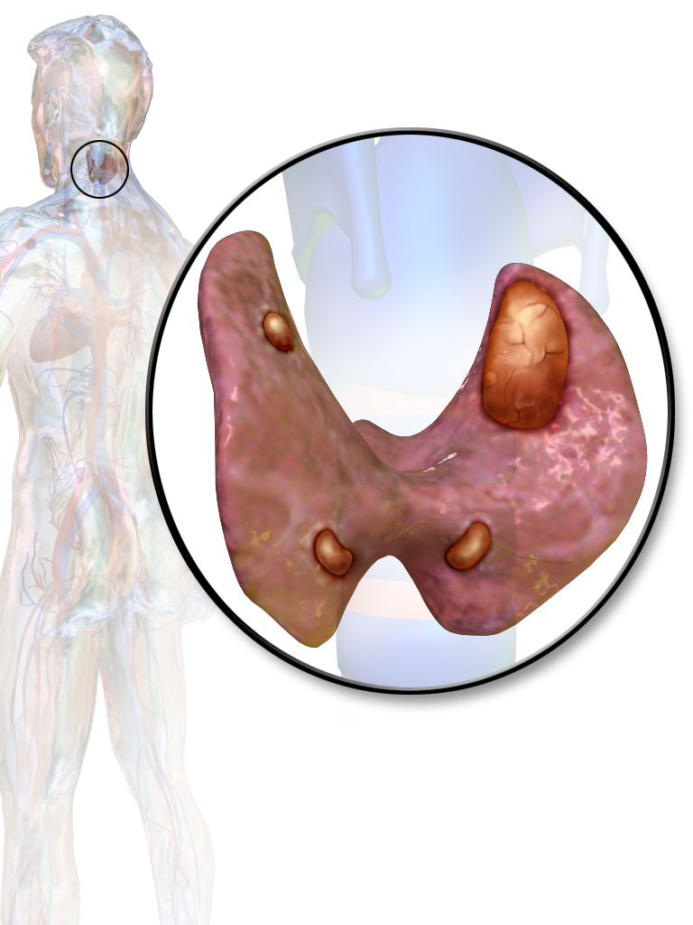 Parathyroid Adenomas Symptoms, causes and their treatment at Dr. Venugopal Pareek clinic, One of the best centers for thyroid removals in Hyderabad