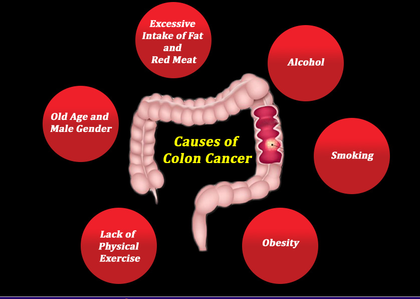 Best doctor for Colorectal Cancer Treatment in Hyderabad, weight loss doctor near me