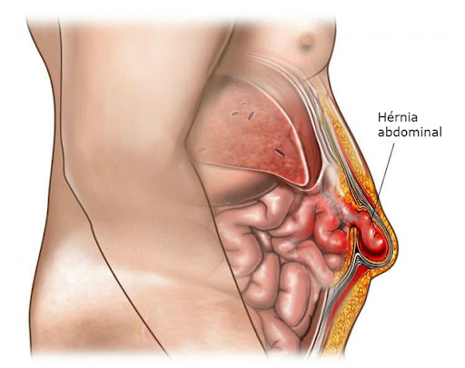 Best Laparoscopic Hernia surgery by Dr V Pareek, One of the best Bariatric surgery specialist in Hyderabad
