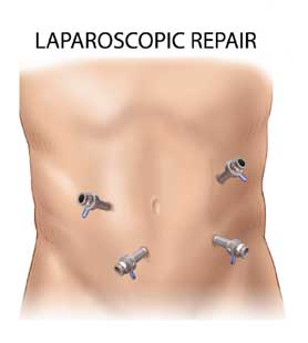 Laparoscopic Hernia Surgery in Hyderabad, hernia surgery hospitals near me