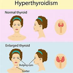 Consult Dr Venugopal Pareek, Best thyroid doctors for thyroid problems treatment in hyderabad