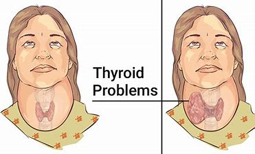 Get the best thyroid disorder treatment Hyderabad by Dr V Pareek, Thyroid Doctor Hyderabad