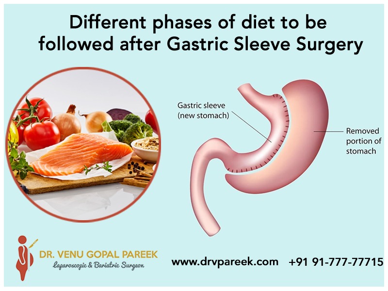 Consult with Dr. Venugopal Pareek, One of the best Gastric sleeve surgery doctor in Hyderabad