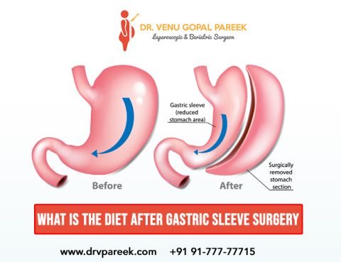 Gastric sleeve surgery in hyderabad By Dr V pareek , Top Gastric sleeve surgery Surgeons in Hyderabad