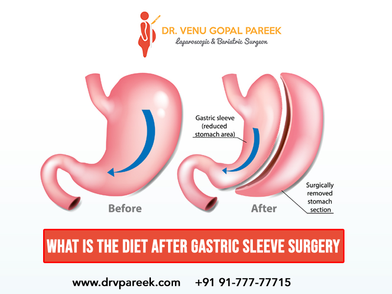 Gastric sleeve surgery in hyderabad By Dr V pareek , Top Gastric sleeve surgery Surgeons in Hyderabad