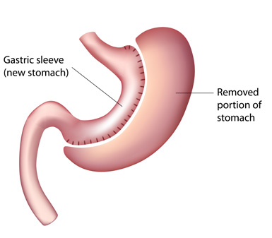 Best Gastric treatment in hyderabad, best gastric sleeve surgery near me