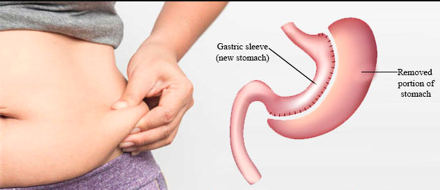 best gastric bypass surgeon near me, weight loss surgery in hyderabad  