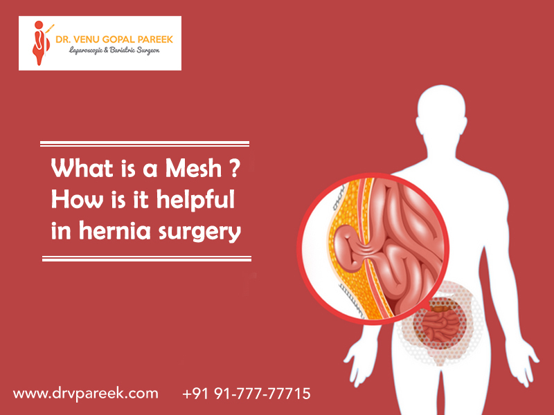 Best Hernia surgery by Dr. V Pareek, One of the best Bariatric and Laparoscopic surgery specialist in Hyderabad