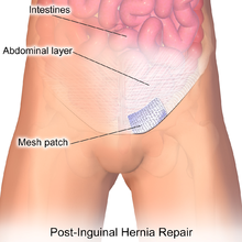 Get now best Hernia Surgery in Hyderabad by Dr Venu Gopal Pareek, hernia surgery hospitals near me