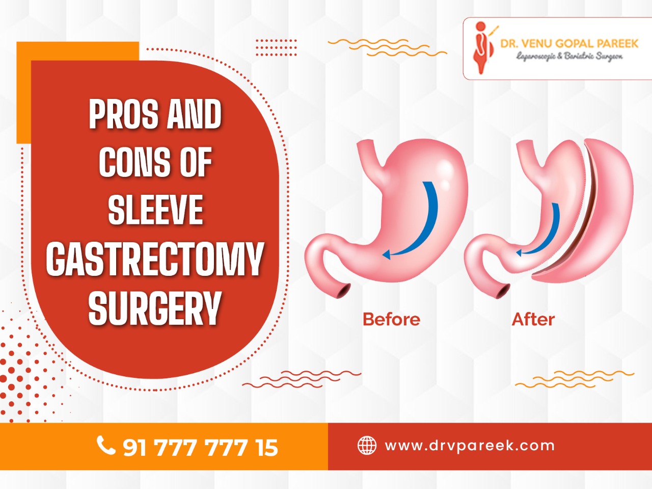 Pros and Cons of sleeve Gastrectomy Surgery